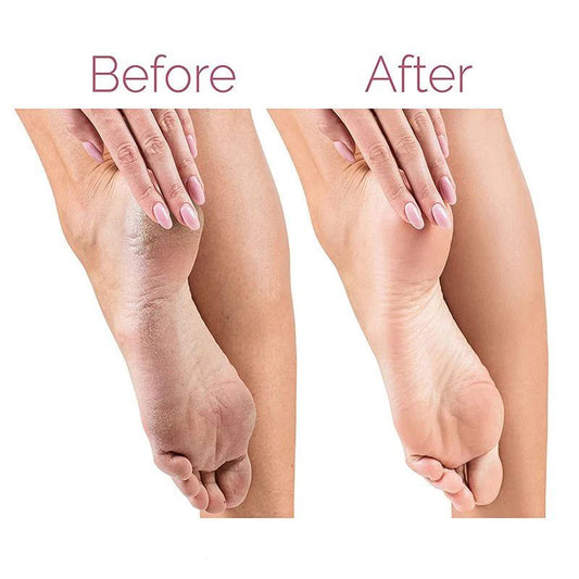 Electric Pedicure Foot File – Callus Remover & Foot Care Tool